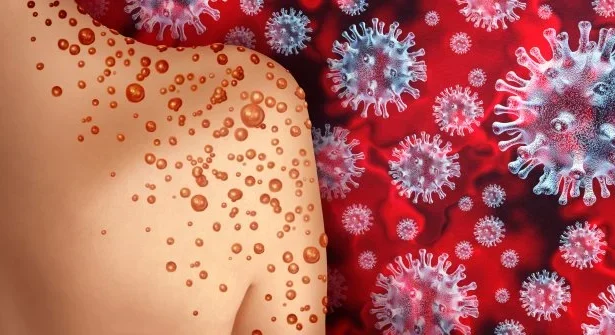 virus-mpox-melonjak