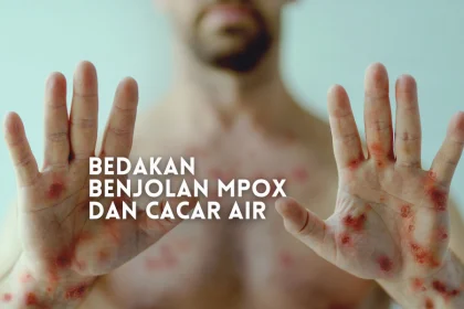 beda mpox dan cacar air