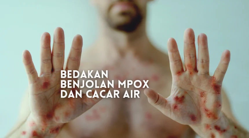 beda mpox dan cacar air